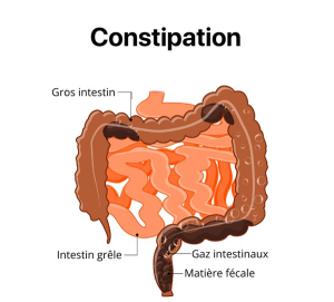 cest quoi la constipation